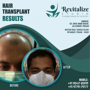 Best Hair Transplant In Jalandhar | Revitalized Studios