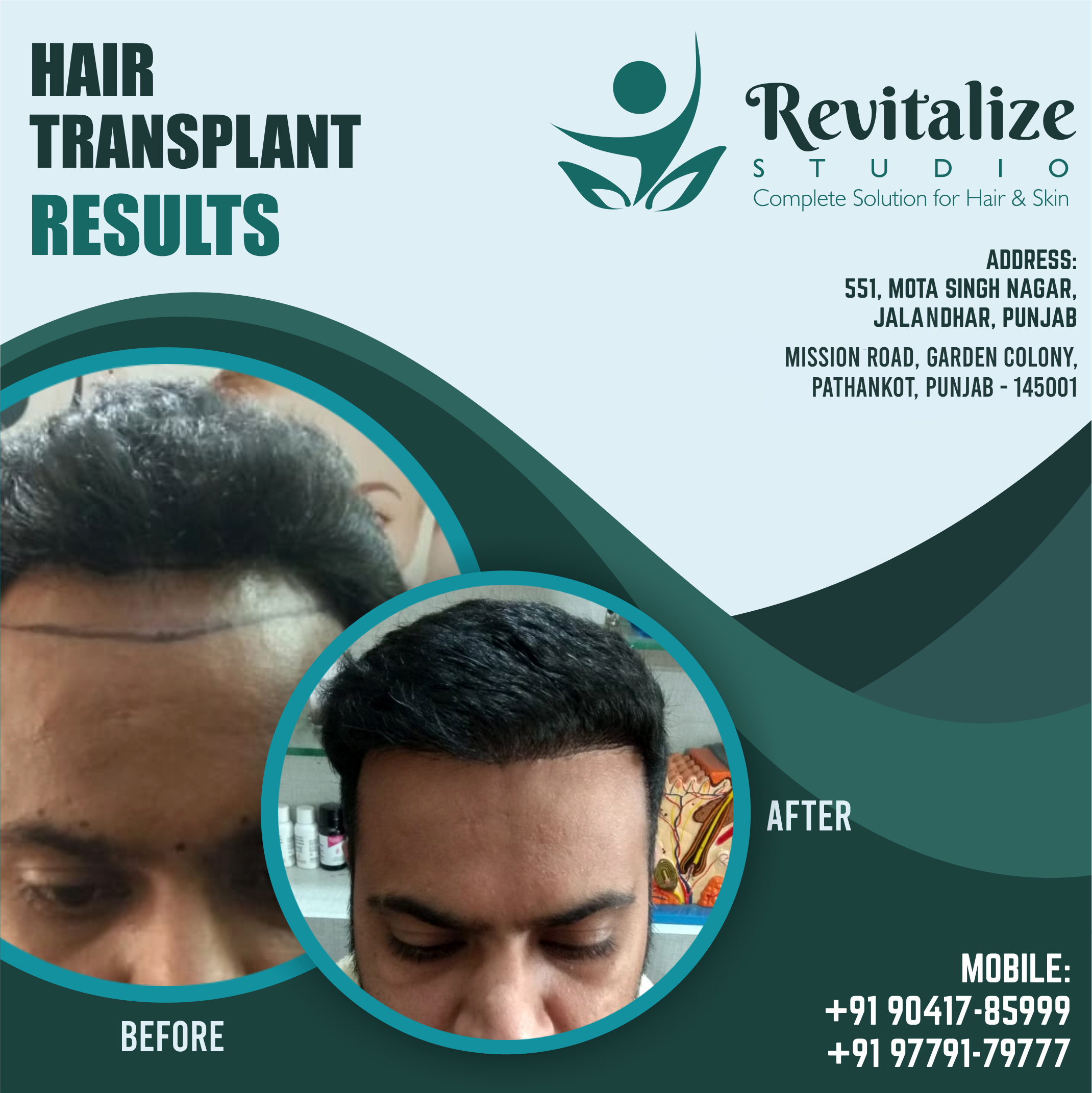 Hair Transplant In Jalandhar Cost | Revitalize Studios, Jalandhar, Punjab
