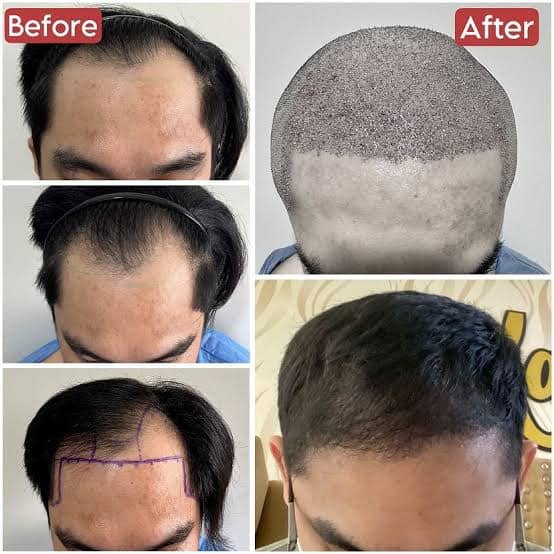Revitalize Studios - Hair Transplant Centre in Jalandhar Punjab India
