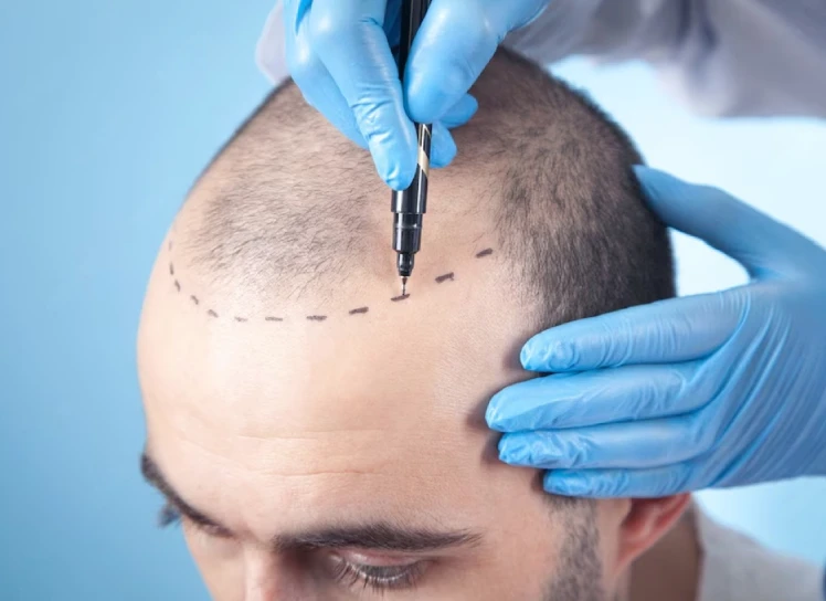 fut hair transplant in jalandhar